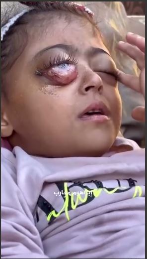 اسرائیل هم کودکیش را دزدید هم چشمانش را !