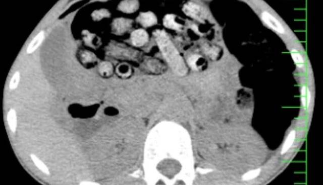 خروج ۹۰ بسته مواد مخدر از معده و روده یک بیمار